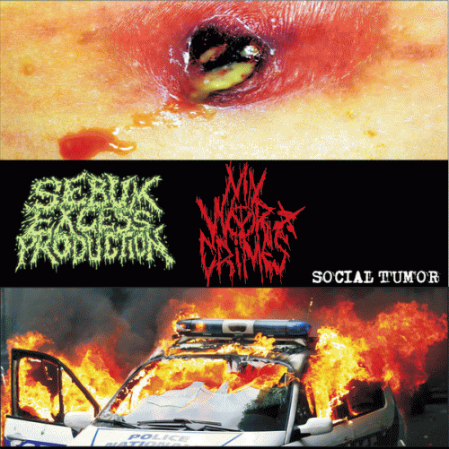 Sebum Excess Production : Social Tumor